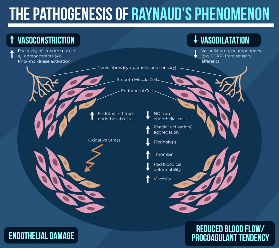 Raynaud's, Raynaud’s Phenomenon: Causes, Symptoms and Support Strategies